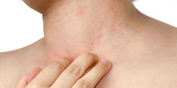 Yosun Alerjisi Belirtileri ve Tedavisi